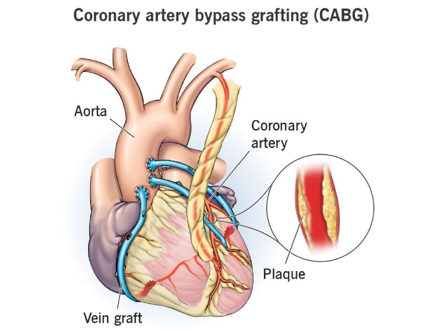 Coronary Artery Bypass Grafting -CABG in India