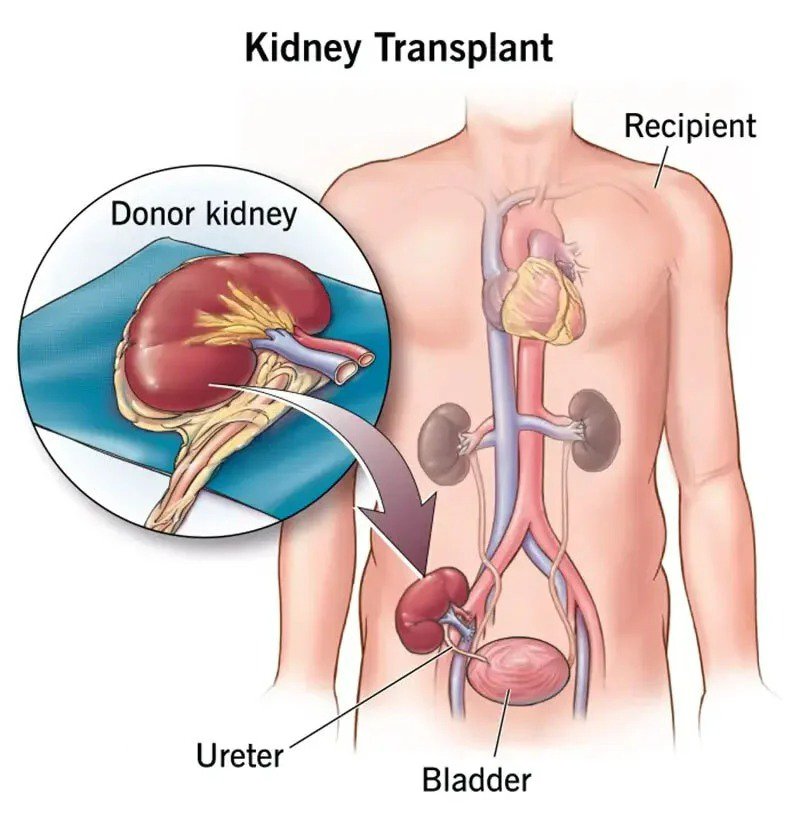 Kidney Transplant in India